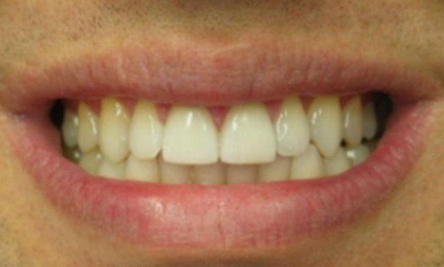 Porcelain-Crowns-in-Clinton-Township-After-Image