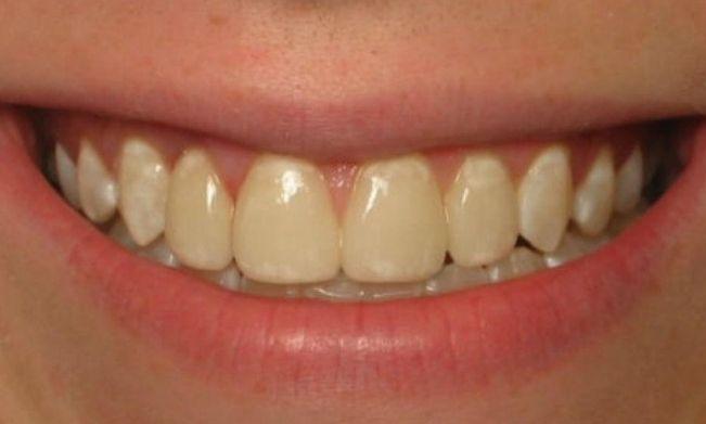 Porcelain-Veneers-in-Clinton-Township-After-Image