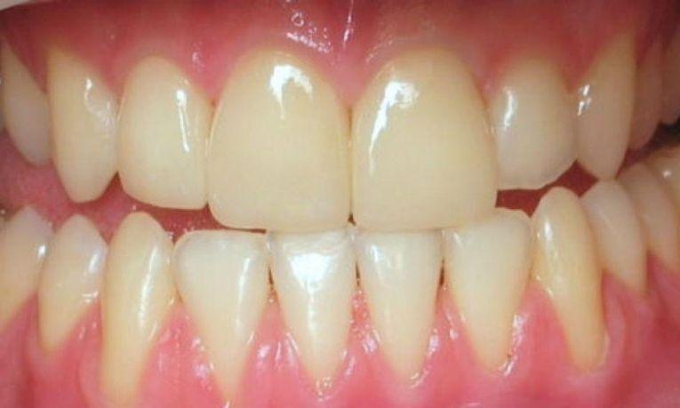 Broken teeth restored in Clinton Township