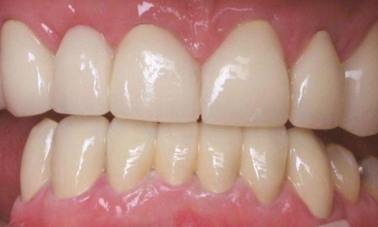Porcelain-Crowns-in-Clinton-Township-After-Image