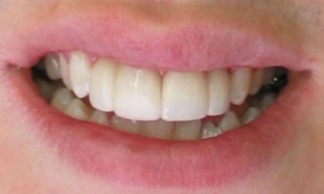 Dental-Bonding-in-Clinton-Township-After-Image
