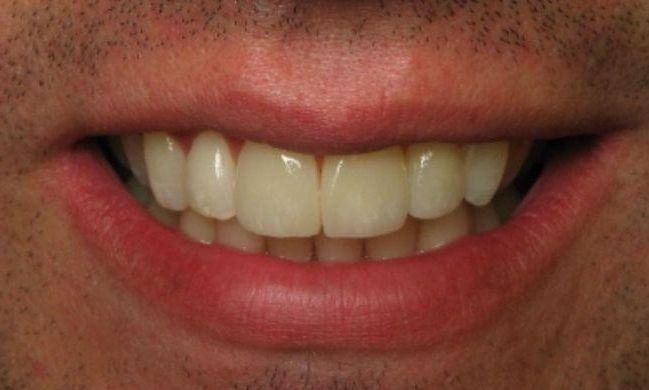 patient before receiving veneers and dental crowns