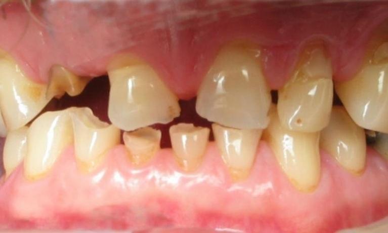 Porcelain-Crowns-in-Clinton-Township-Before-Image