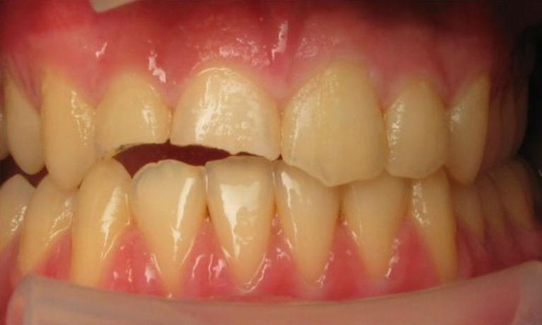 Patient with broken teeth