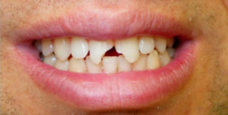 Porcelain-Crowns-in-Clinton-Township-Before-Image