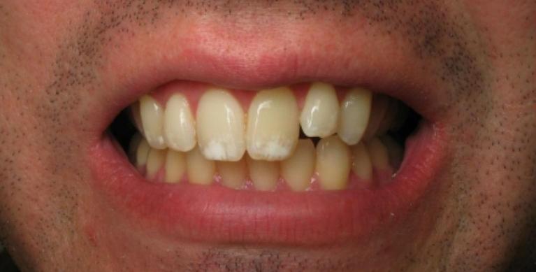 Patient before receiving porcelain veneers and crowns