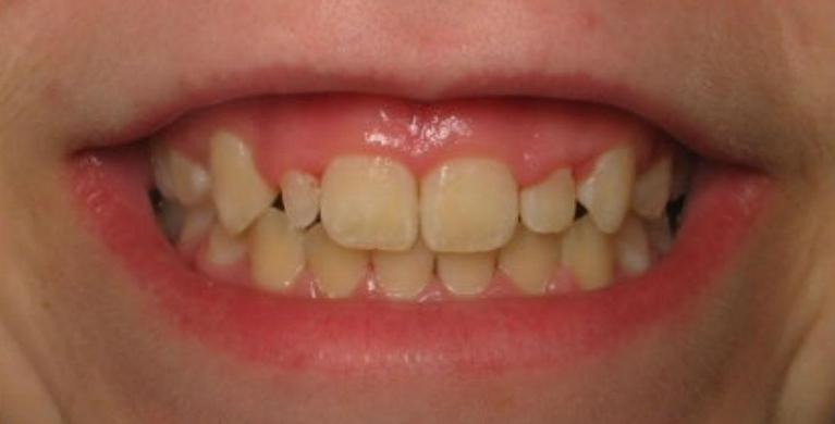 Patient before dental veneers