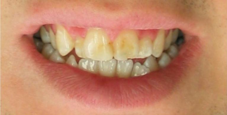Dental-Bonding-in-Clinton-Township-Before-Image
