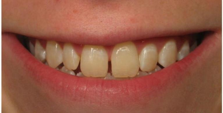 Porcelain-Veneers-in-Clinton-Township-Before-Image